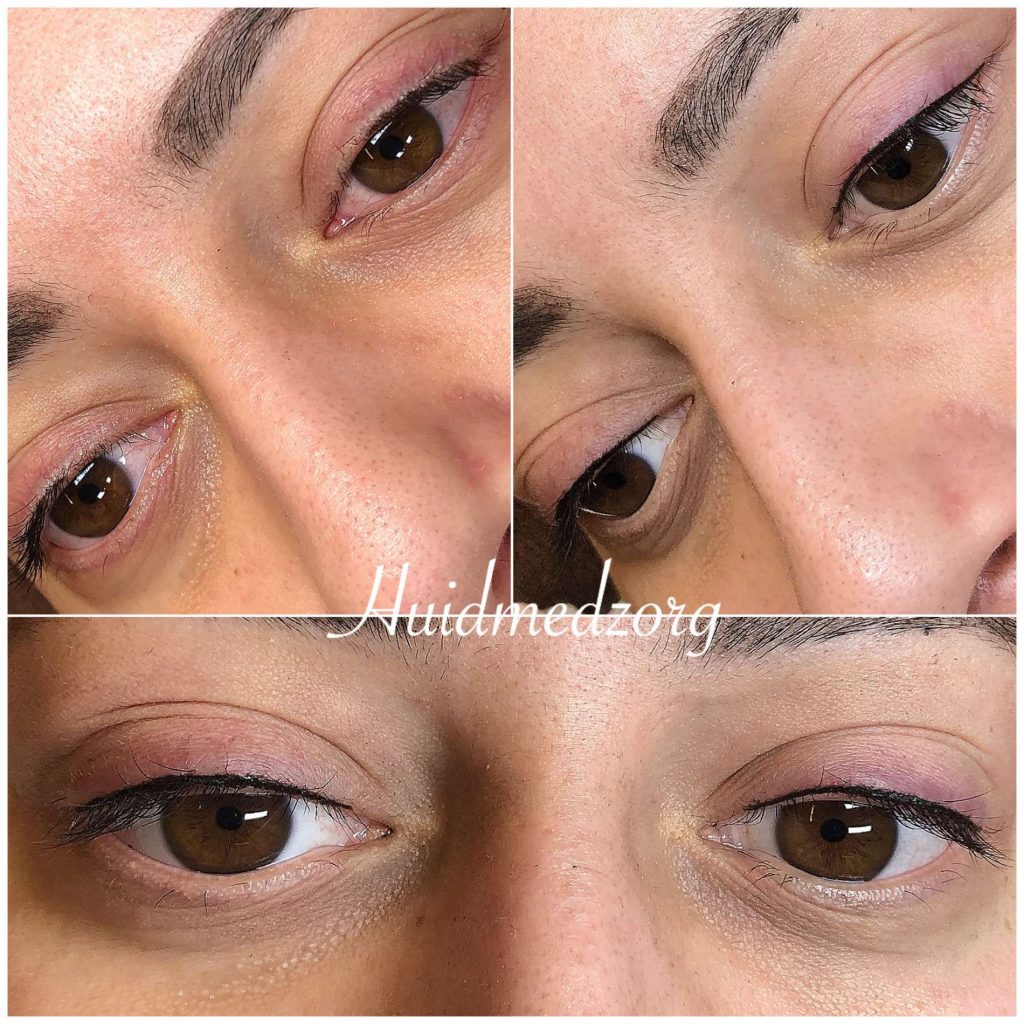 Permanent Make-up Eyeliner boven Wassenaar | Huidmedzorg
