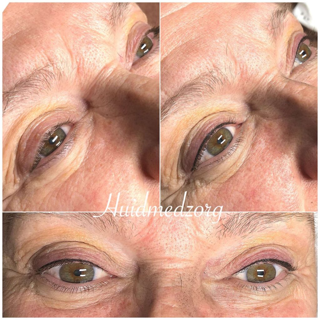 Tatoeage Eyeliner boven Wassenaar | Huidmedzorg
